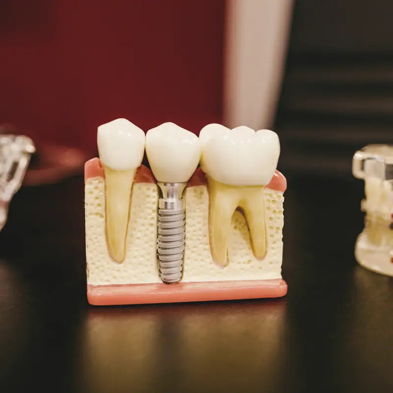 Ovako implant izgleda na modelu: koren od titanijuma, krunica iznad.